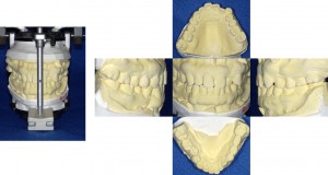 歯の模型 術前
